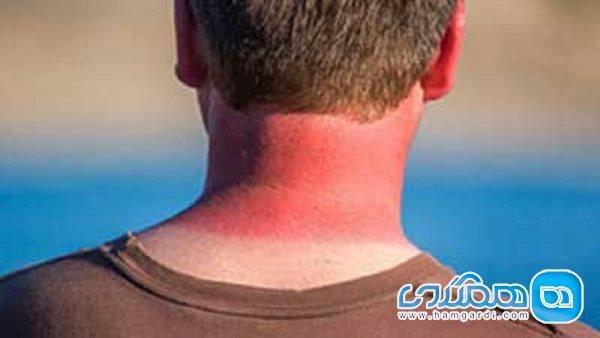 آفتاب سوختگی بیش از حد چه بلایی سرتان می آورد؟