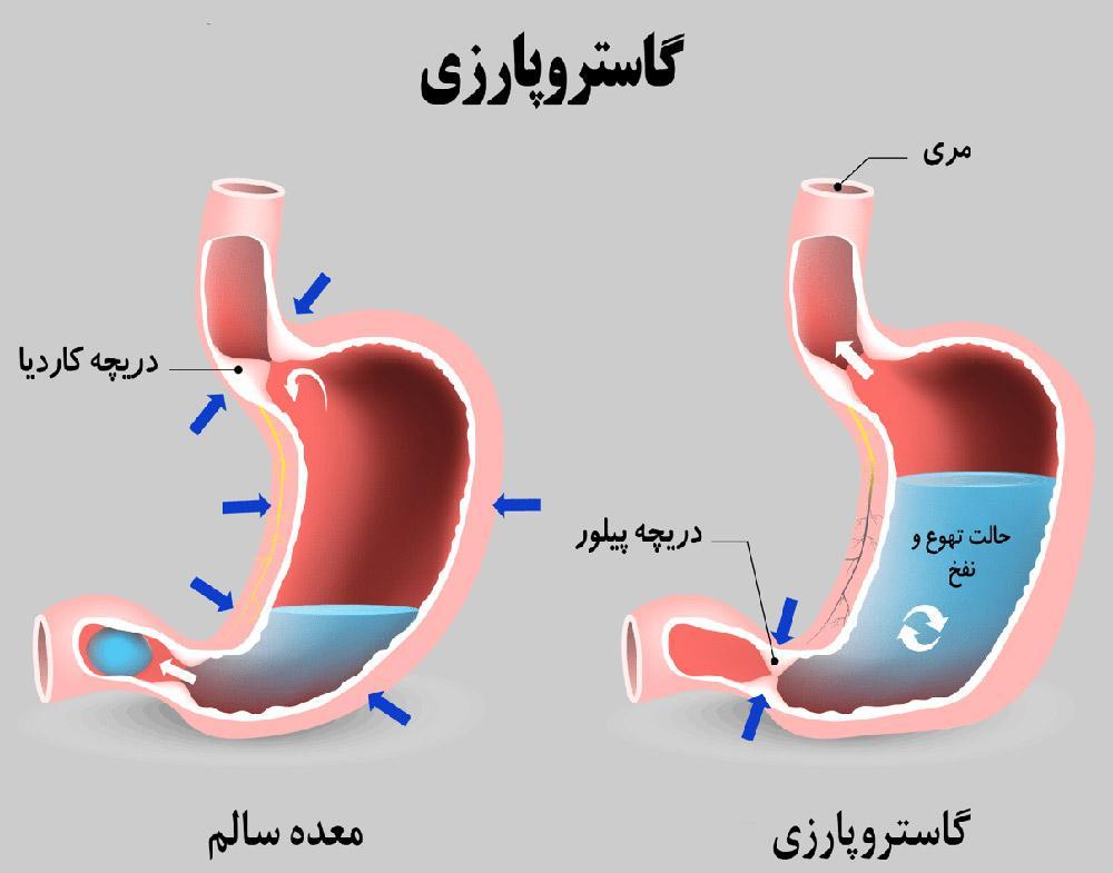وقتی معده فلج می شود؛ از علائم تا درمان وقتی معده فلج می شود؛ از علائم تا درمان