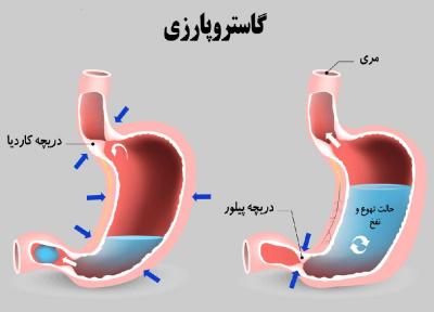 وقتی معده فلج می شود؛ از علائم تا درمان