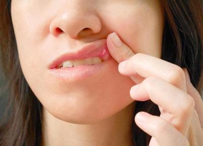 درمان آفت دهان با روش های پزشکی و خانگی