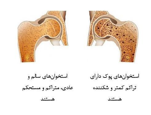 درمان پوکی استخوان با توکوترینول های موجود در روغن پالم درمان پوکی استخوان با توکوترینول های موجود در روغن پالم