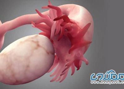 سرطان تخمدان؛ از علائم تا پیشگیری