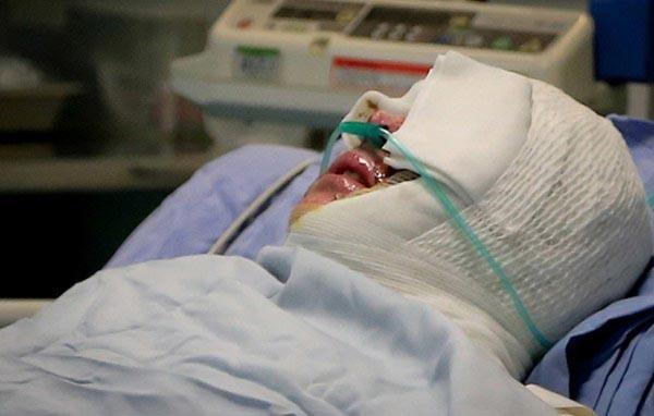 اسیدپاشی به پسر 21 ساله در مشهد